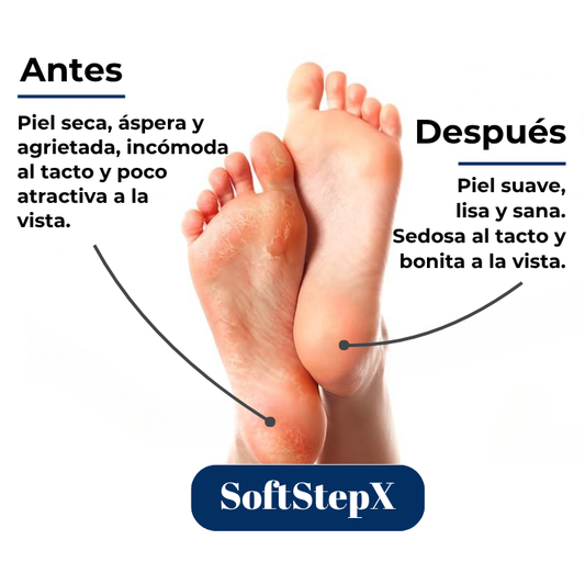 SoftStepX™ - La belleza empieza en tus pies en pocos dias.